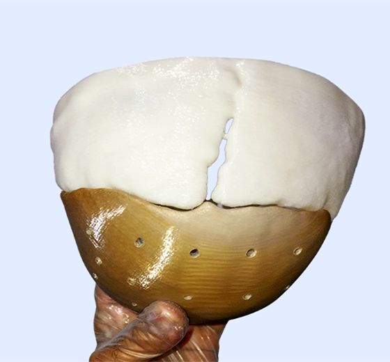 Cranium PEEK implant case 03